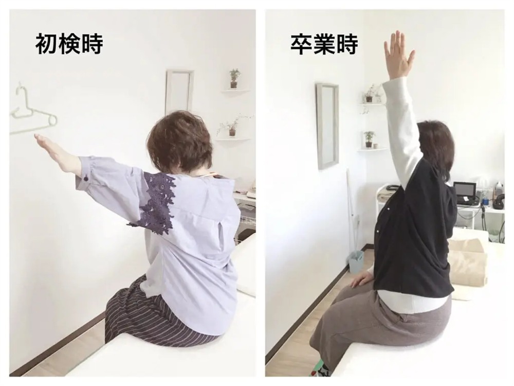 五十肩の初検時と卒業時の比較写真。初検時は腕が100°位しか上がらない状態から、卒業時には垂直まで真っ直ぐ腕が上がるように改善された50代の患者様の様子