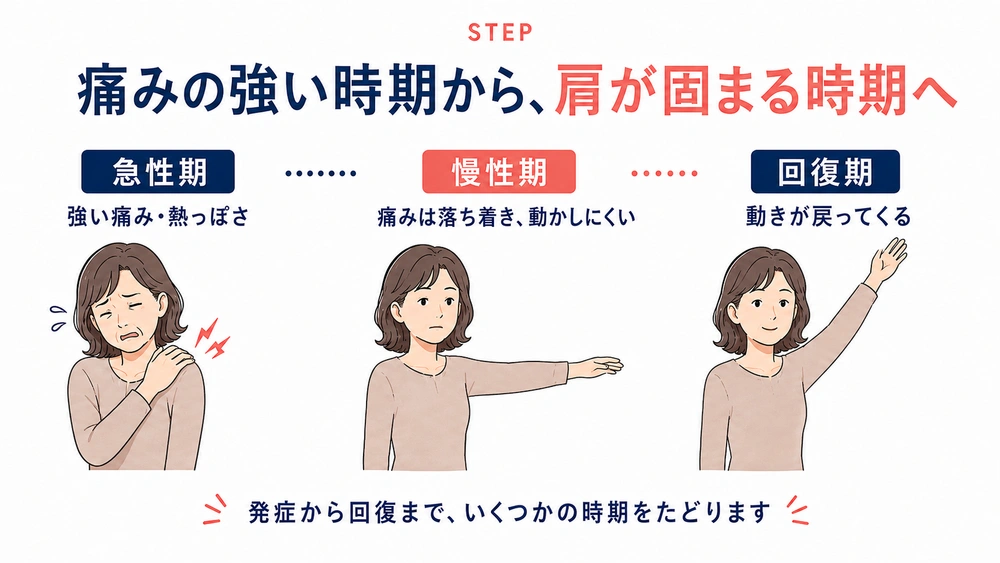| 五十肩の急性期・慢性期・回復期について、強い痛みや熱っぽさから肩の動きが戻るまでの変化を示す図解