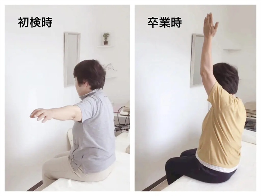 「初検時」と「卒業時」を比較した60代の女性患者様の写真。施術前は左腕が約90°にしか上がらなかったのが、卒業時は腕が約170°まで上がるようになった様子