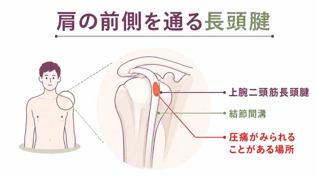 肩の前面から見た上腕二頭筋長頭腱と結節間溝、圧痛がみられることがある位置の目安を示す図解