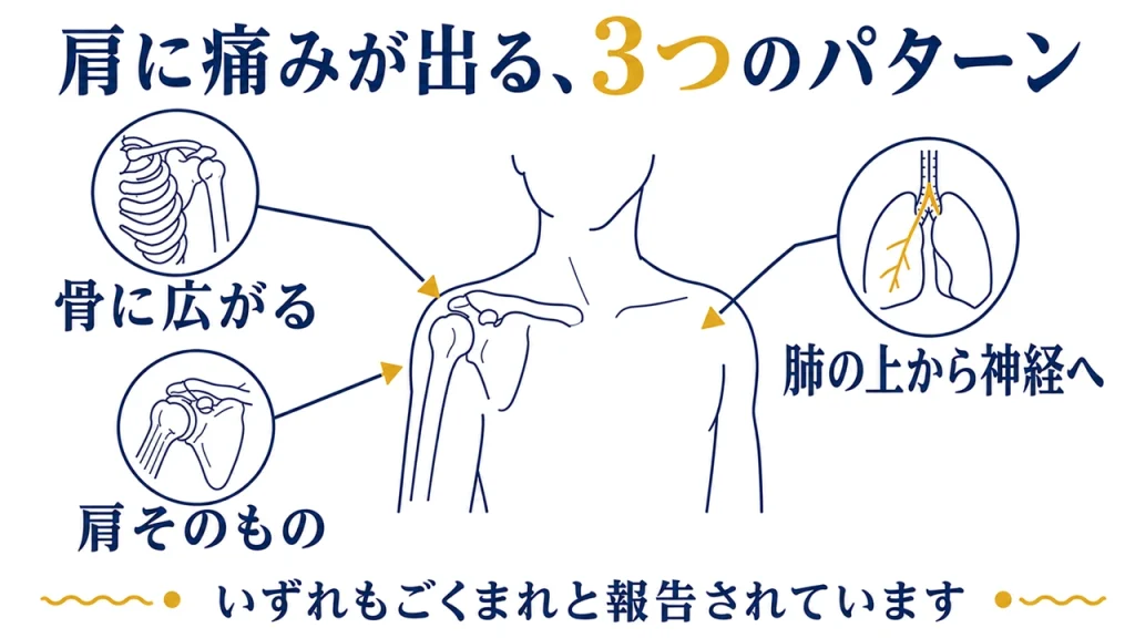 肩に痛みが出る3つのパターン（骨に広がる／肺の上から神経へ／肩そのもの）を、上半身の図と肩関節・肺のイラストで示した図解。いずれもごくまれと報告されています